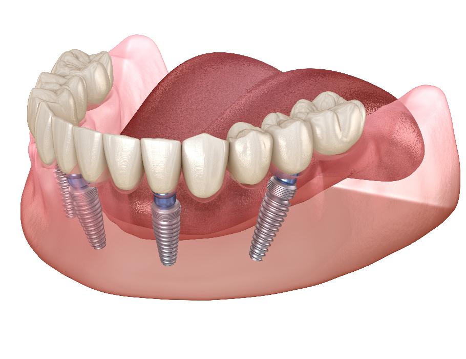Model of a dental crown and implants In Annapolis,MD