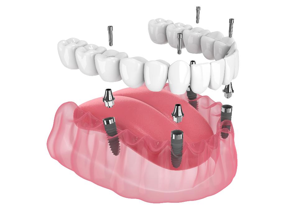 Talk To a Top Dental Implant Dentist in Annapolis, MD!