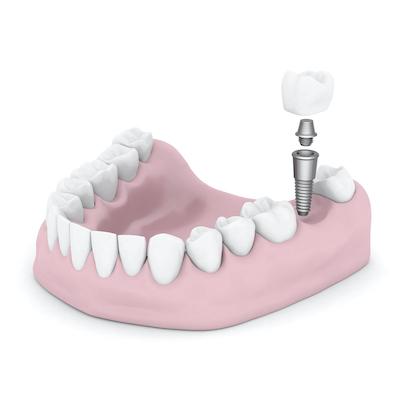 An illustration of a tooth implant in Annapolis, MD