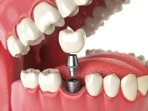 An illustration of dental implants in Annapolis, MD.