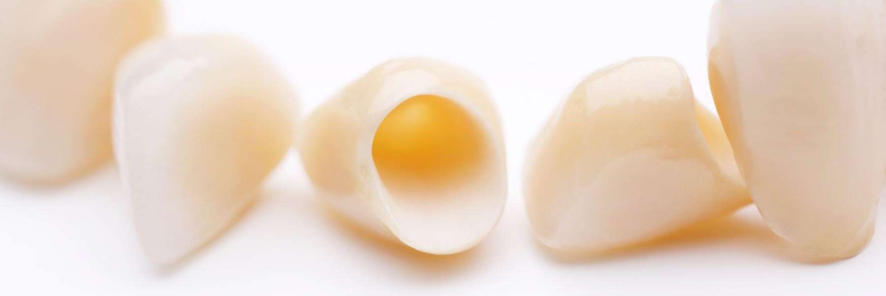 A model of Dental Crowns in Annapolis, MD.