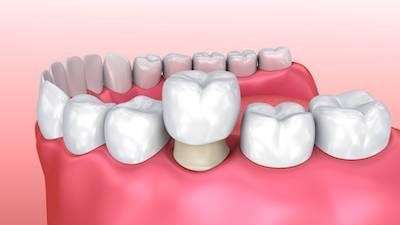 A model of dental crowns in Annapolis, MD.