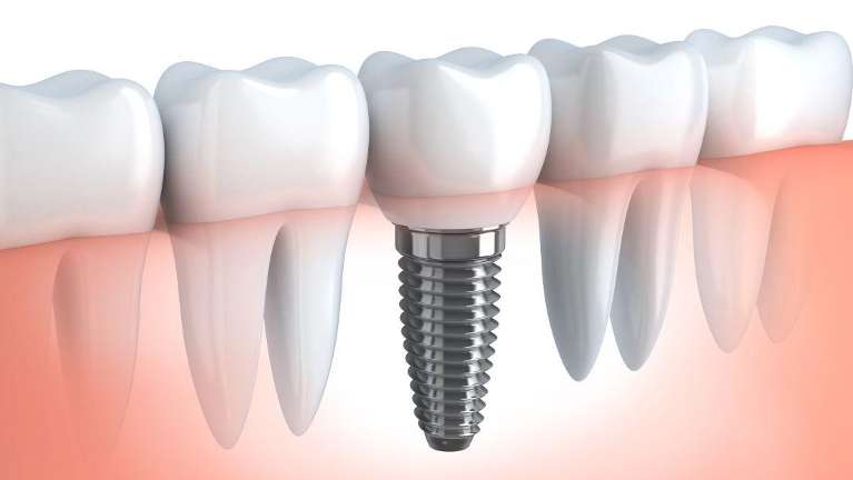 An illustration of dental implant in crown at Chesapeake Bay Dentistry