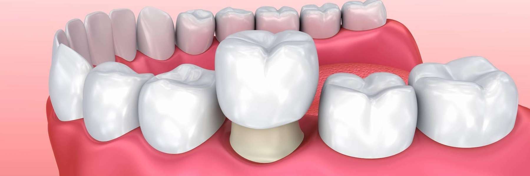 An Illustration of a Dental Crown in Annapolis, MD