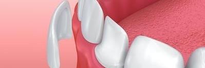 graphic of a porcelain veneer in annapolis md