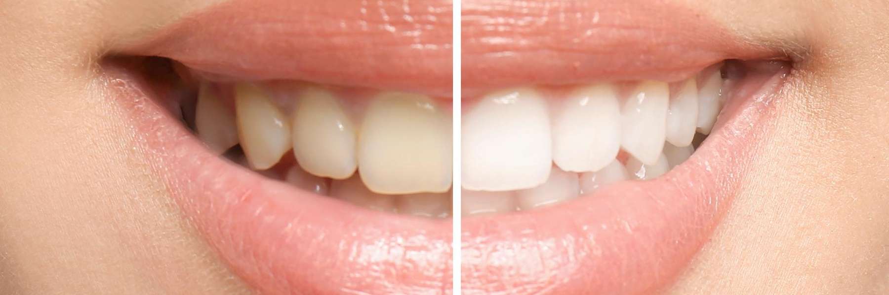 A side by side Teeth whitening result in Annapolis, MD